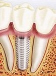 Implantes