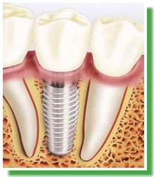 Implantes